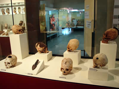 MUSEO REGIONAL DE ICA TREPANACION CRANEANA 02