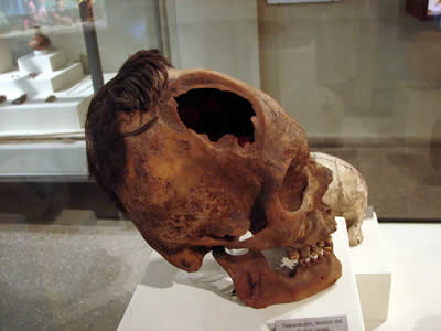 MUSEO REGIONAL DE ICA TREPANACION CRANEANA 03