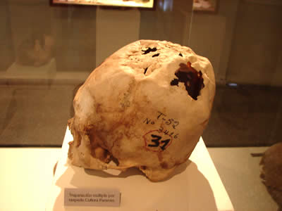 MUSEO REGIONAL DE ICA TREPANACION CRANEANA 05